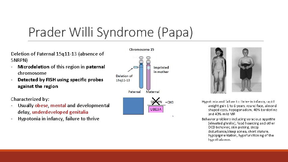 Prader Willi Syndrome (Papa) Deletion of Paternal 15 q 11 -13 (absence of SNRPN) Prader Willi Syndrome (Papa) Deletion of Paternal 15 q 11 -13 (absence of SNRPN)