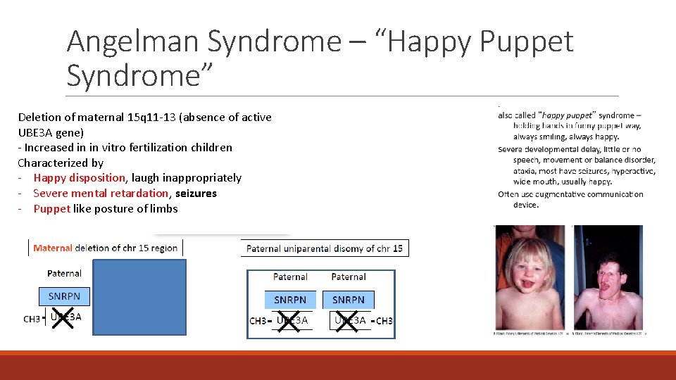 Angelman Syndrome – “Happy Puppet Syndrome” Deletion of maternal 15 q 11 -13 (absence Angelman Syndrome – “Happy Puppet Syndrome” Deletion of maternal 15 q 11 -13 (absence