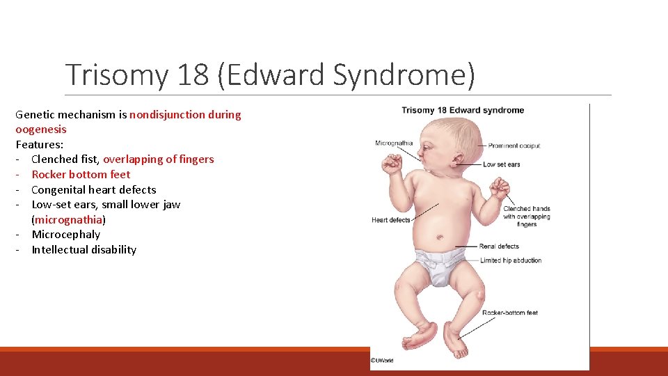 Trisomy 18 (Edward Syndrome) Genetic mechanism is nondisjunction during oogenesis Features: - Clenched fist, Trisomy 18 (Edward Syndrome) Genetic mechanism is nondisjunction during oogenesis Features: - Clenched fist,