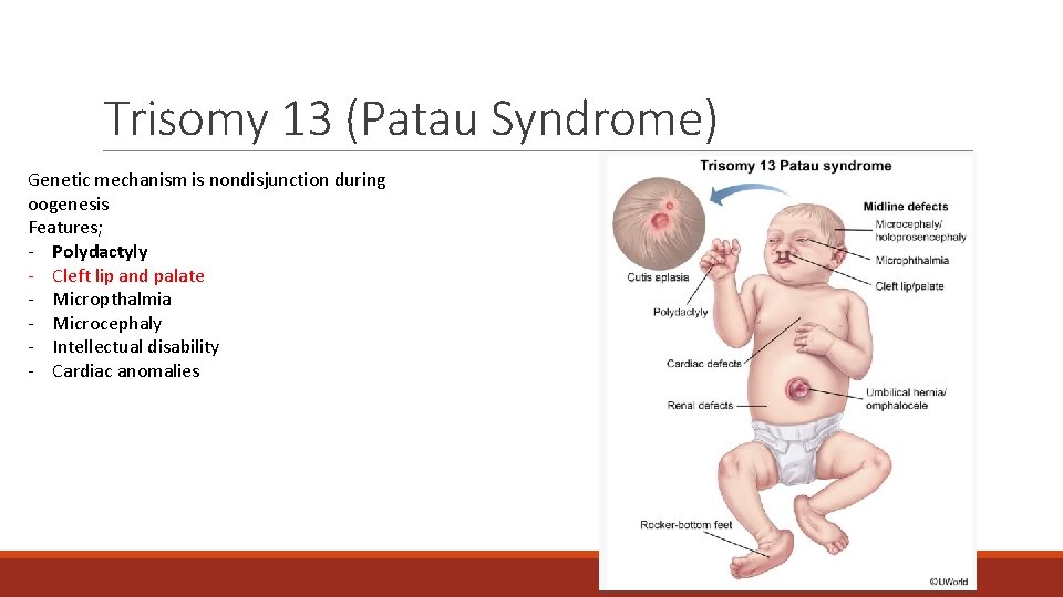 Trisomy 13 (Patau Syndrome) Genetic mechanism is nondisjunction during oogenesis Features; - Polydactyly - Trisomy 13 (Patau Syndrome) Genetic mechanism is nondisjunction during oogenesis Features; - Polydactyly -