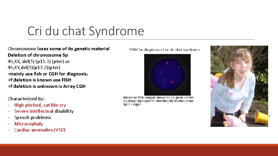 Cri du chat Syndrome Chromosome loses some of its genetic material Deletion of chromosome Cri du chat Syndrome Chromosome loses some of its genetic material Deletion of chromosome