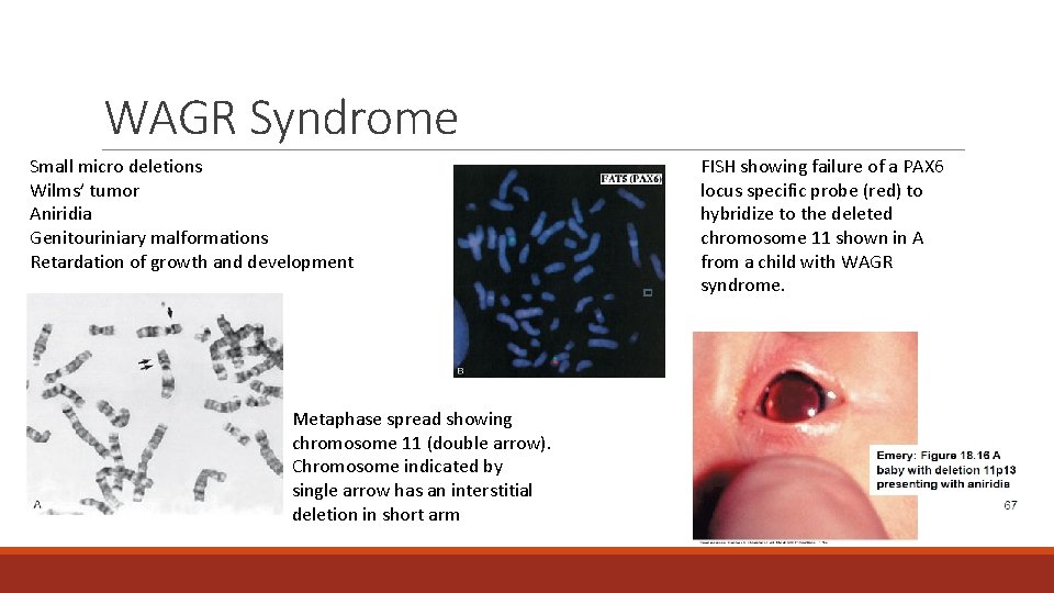WAGR Syndrome Small micro deletions Wilms’ tumor Aniridia Genitouriniary malformations Retardation of growth and WAGR Syndrome Small micro deletions Wilms’ tumor Aniridia Genitouriniary malformations Retardation of growth and