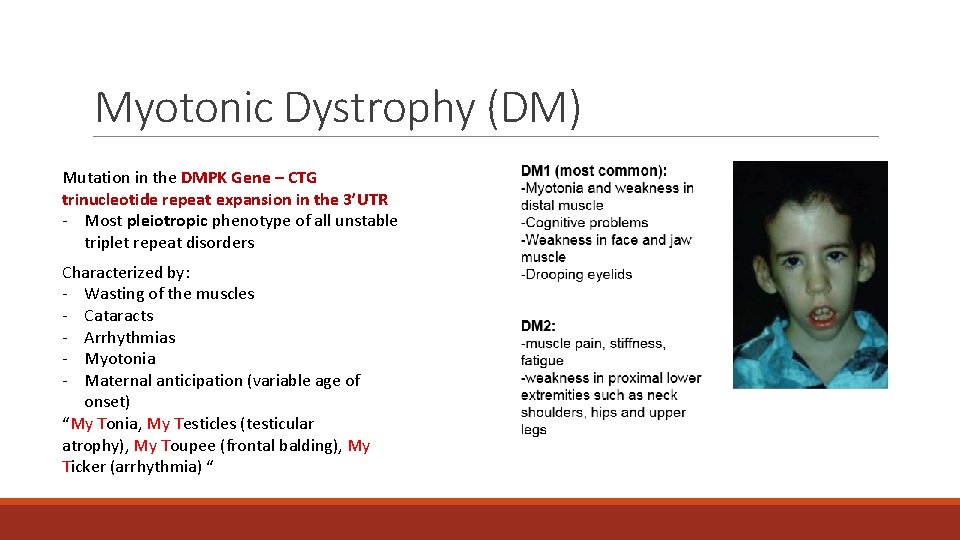Myotonic Dystrophy (DM) Mutation in the DMPK Gene – CTG trinucleotide repeat expansion in Myotonic Dystrophy (DM) Mutation in the DMPK Gene – CTG trinucleotide repeat expansion in