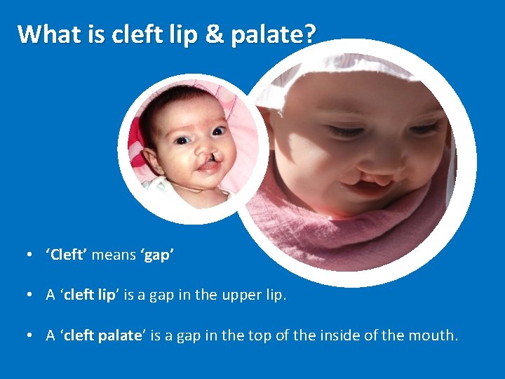 What is cleft lip & palate? • ‘Cleft’ means ‘gap’ • A ‘cleft lip’