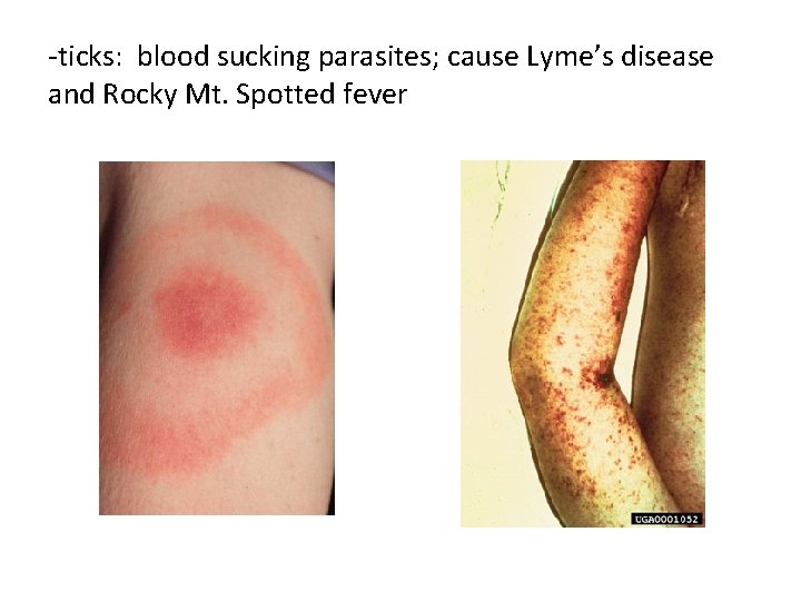 -ticks: blood sucking parasites; cause Lyme’s disease and Rocky Mt. Spotted fever 