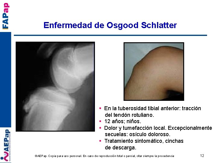 Enfermedad de Osgood Schlatter § En la tuberosidad tibial anterior: tracción del tendón rotuliano.