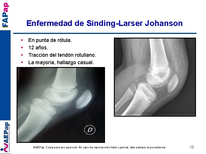 Enfermedad de Sinding-Larser Johanson § § En punta de rótula. 12 años. Tracción del