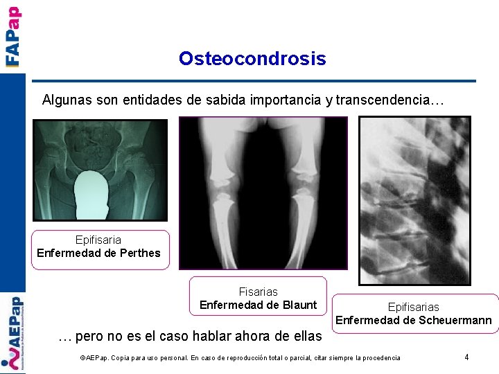 Osteocondrosis Algunas son entidades de sabida importancia y transcendencia… Epifisaria Enfermedad de Perthes Fisarias