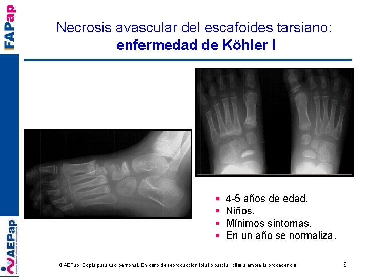 Necrosis avascular del escafoides tarsiano: enfermedad de Köhler I § § 4 -5 años