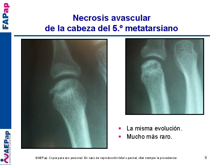 Necrosis avascular de la cabeza del 5. º metatarsiano § La misma evolución. §