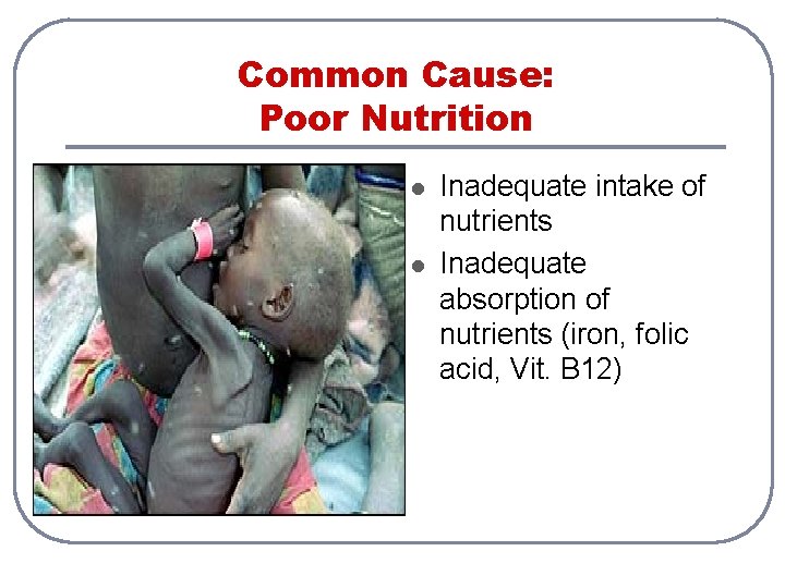 Common Cause: Poor Nutrition l l Inadequate intake of nutrients Inadequate absorption of nutrients