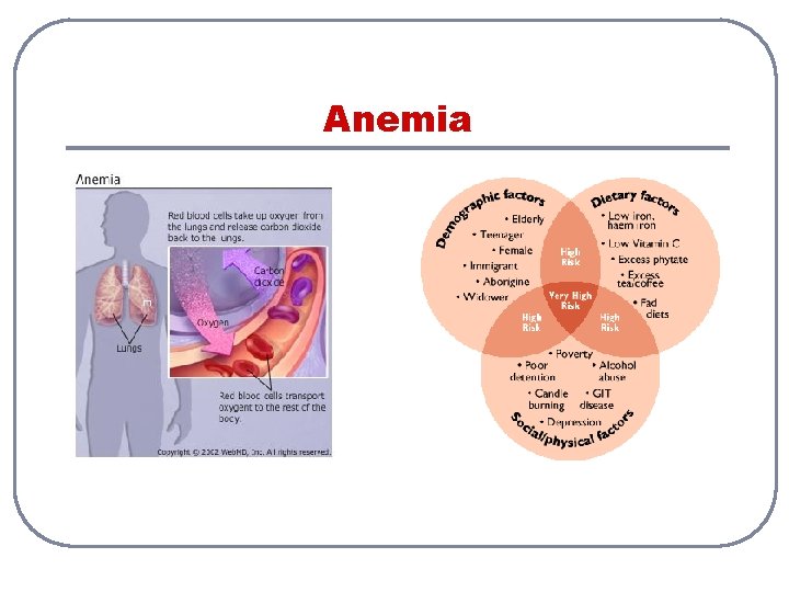 Anemia 