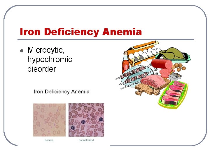 Iron Deficiency Anemia l Microcytic, hypochromic disorder 