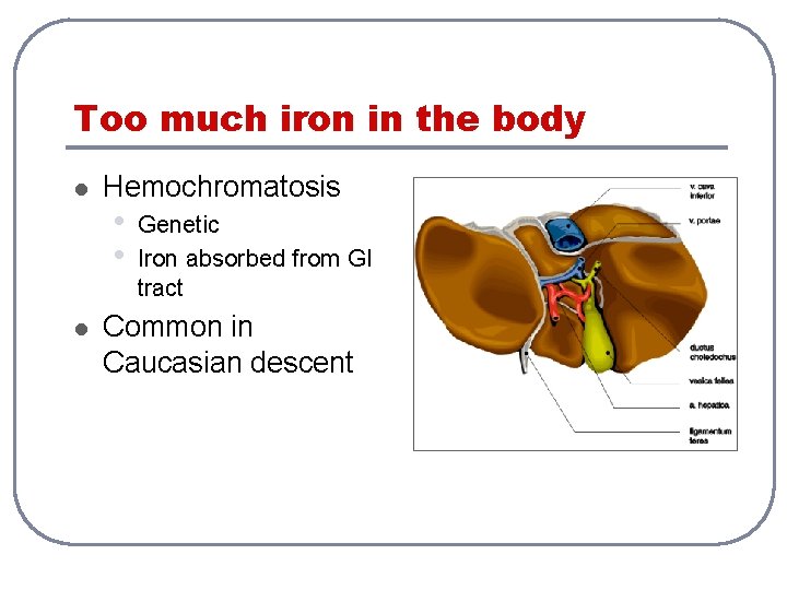 Too much iron in the body l l Hemochromatosis • • Genetic Iron absorbed