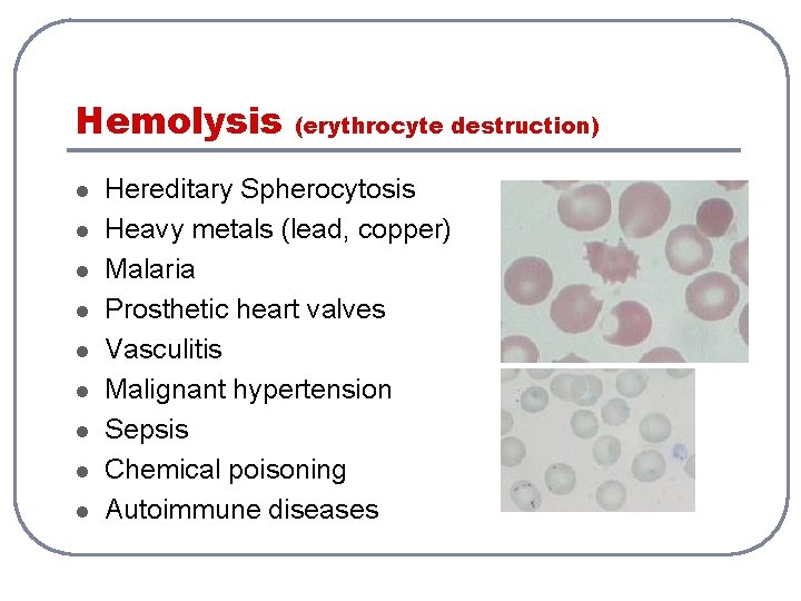 Hemolysis l l l l l (erythrocyte destruction) Hereditary Spherocytosis Heavy metals (lead, copper) Hemolysis l l l l l (erythrocyte destruction) Hereditary Spherocytosis Heavy metals (lead, copper)