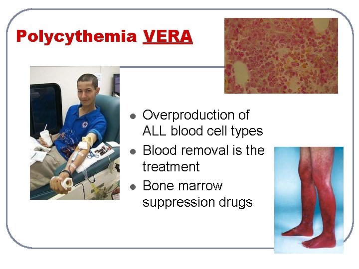 Polycythemia VERA l l l Overproduction of ALL blood cell types Blood removal is