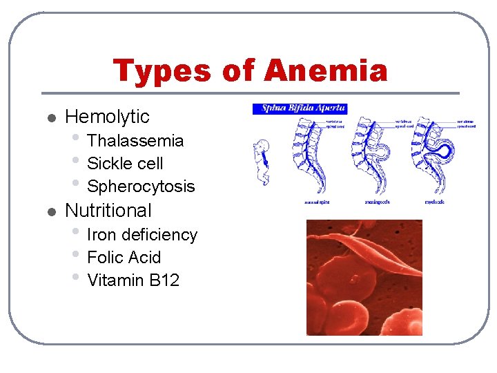 Types of Anemia l Hemolytic l Nutritional • Thalassemia • Sickle cell • Spherocytosis