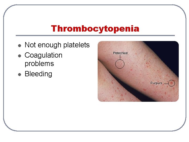 Thrombocytopenia l l l Not enough platelets Coagulation problems Bleeding 