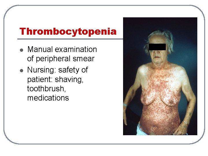 Thrombocytopenia l l Manual examination of peripheral smear Nursing: safety of patient: shaving, toothbrush,