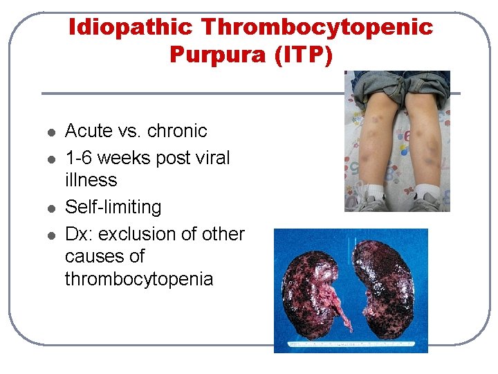 Idiopathic Thrombocytopenic Purpura (ITP) l l Acute vs. chronic 1 -6 weeks post viral