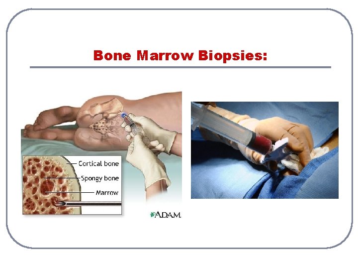 Bone Marrow Biopsies: 