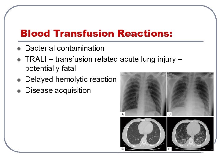 Blood Transfusion Reactions: l l Bacterial contamination TRALI – transfusion related acute lung injury Blood Transfusion Reactions: l l Bacterial contamination TRALI – transfusion related acute lung injury