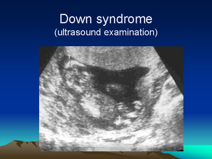 Down syndrome (ultrasound examination) 