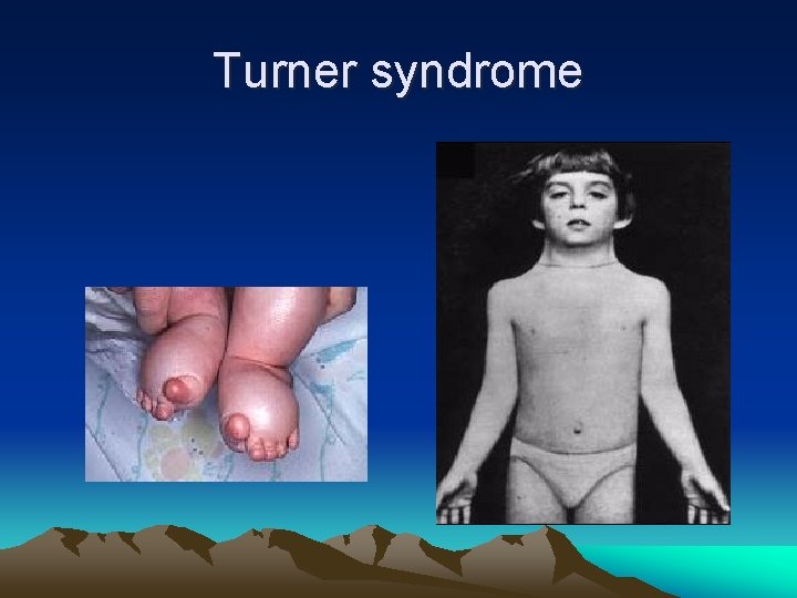 Turner syndrome 