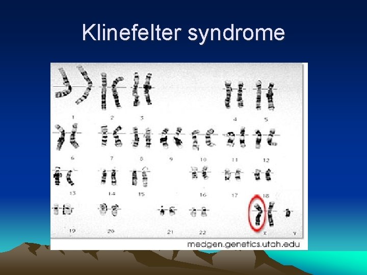 Klinefelter syndrome 