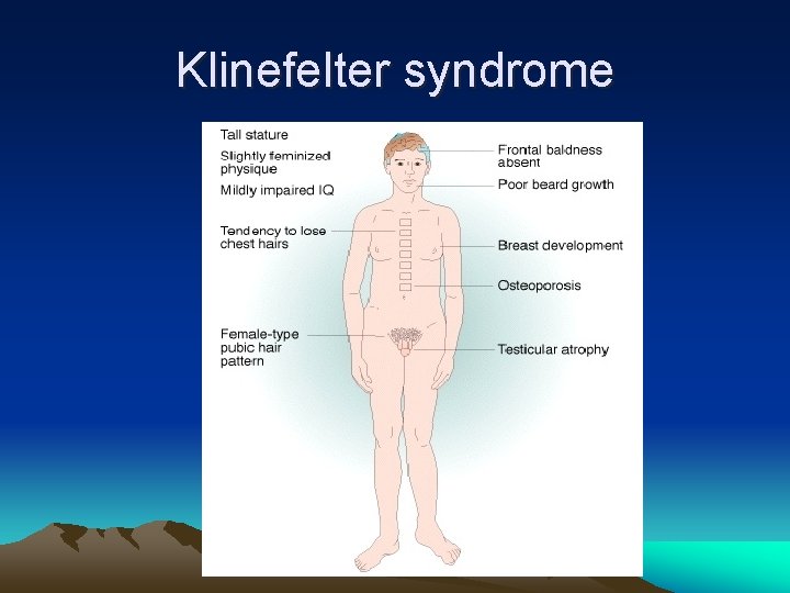 Klinefelter syndrome 