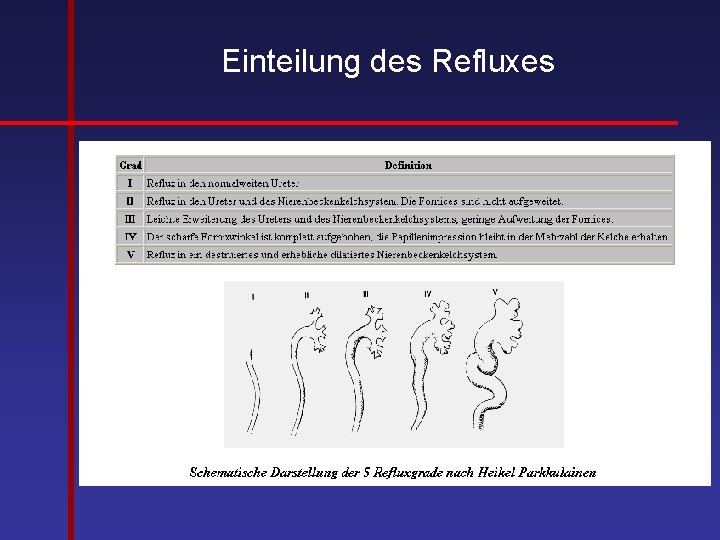 Einteilung des Refluxes 