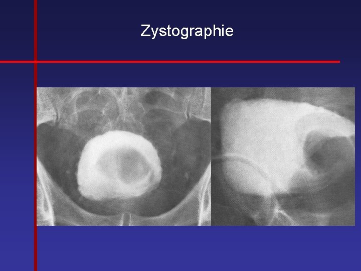 Zystographie 