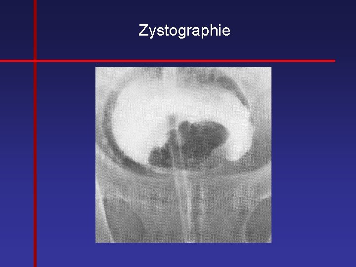 Zystographie 