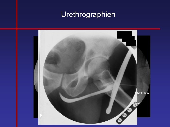 Urethrographien Pars membranacea Ampulla urethrae Pars spongiosa 