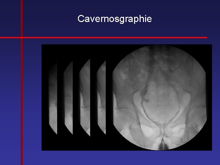 Cavernosgraphie 