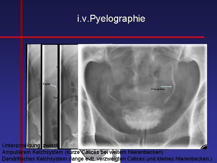 i. v. Pyelographie Calix minor Infundibulum Pyelouretraler Übergang Calix major Papille Pars abdominalis Pars