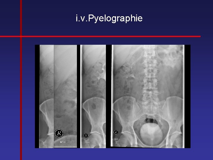 i. v. Pyelographie 