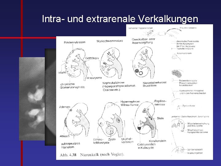 Intra- und extrarenale Verkalkungen 