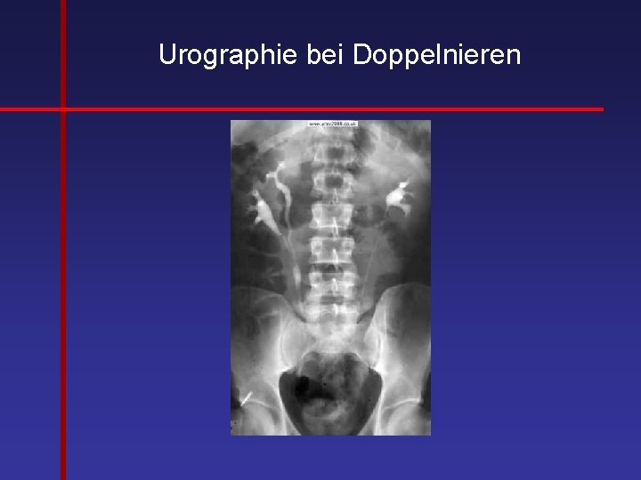 Urographie bei Doppelnieren 