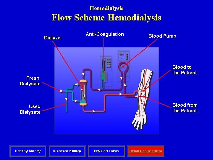 Hemodialysis Flow Scheme Hemodialysis Dialyzer Anti-Coagulation Blood Pump Blood to the Patient Fresh Dialysate