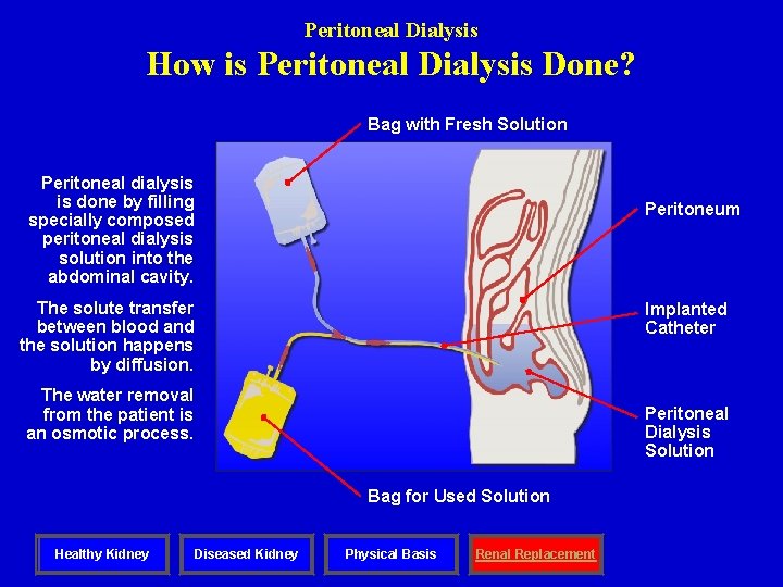 Peritoneal Dialysis How is Peritoneal Dialysis Done? Bag with Fresh Solution Peritoneal dialysis is