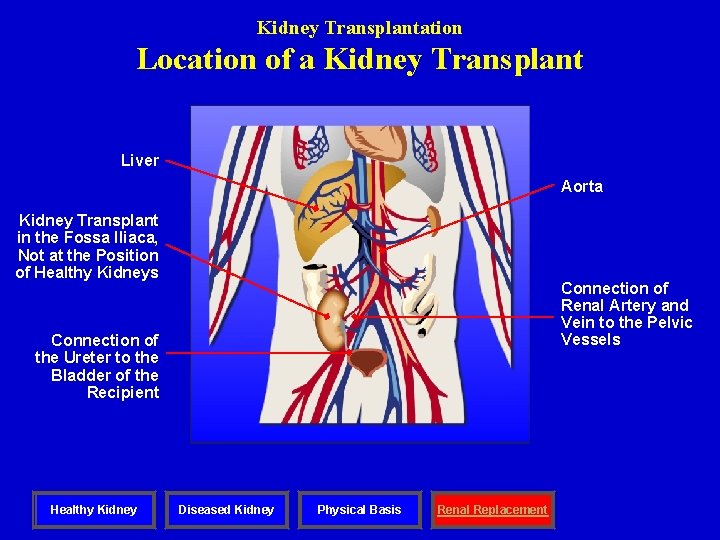 Kidney Transplantation Location of a Kidney Transplant Liver Aorta Kidney Transplant in the Fossa