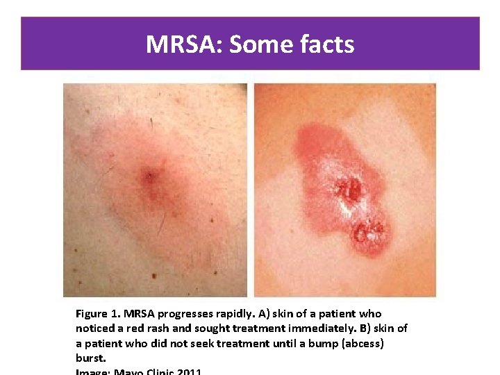 MRSA: Some facts Figure 1. MRSA progresses rapidly. A) skin of a patient who