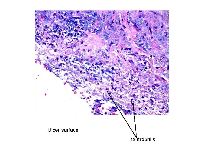 Ulcer surface neutrophils 