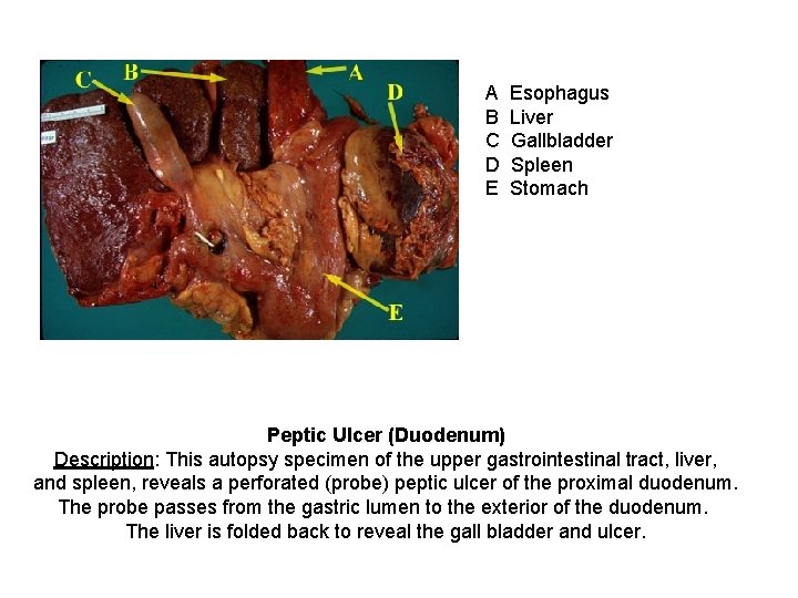 A B C D E Esophagus Liver Gallbladder Spleen Stomach Peptic Ulcer (Duodenum) Description: