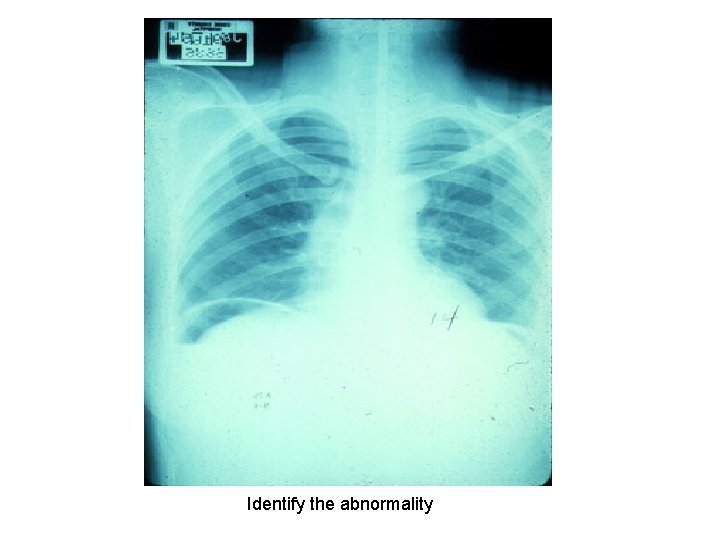 Identify the abnormality 