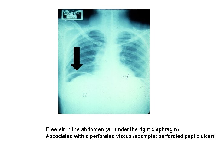 Free air in the abdomen (air under the right diaphragm) Associated with a perforated