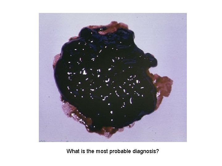 What is the most probable diagnosis? 