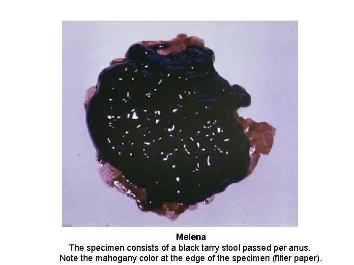 Melena The specimen consists of a black tarry stool passed per anus. Note the