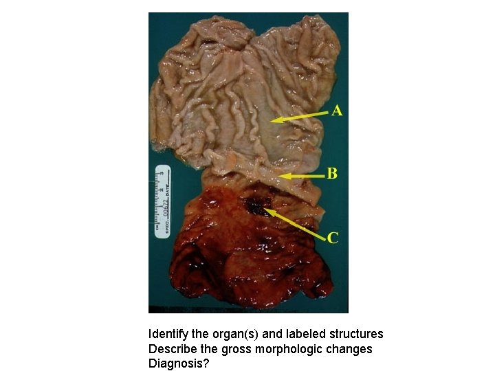 Identify the organ(s) and labeled structures Describe the gross morphologic changes Diagnosis? 